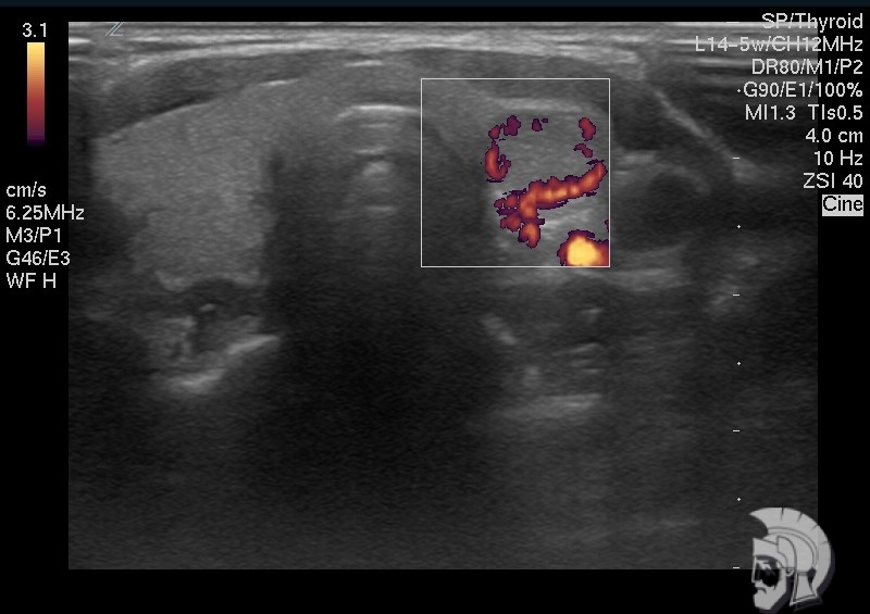 Узел в левой доле щитовидной железы Узел в левой доле щитовидной железы